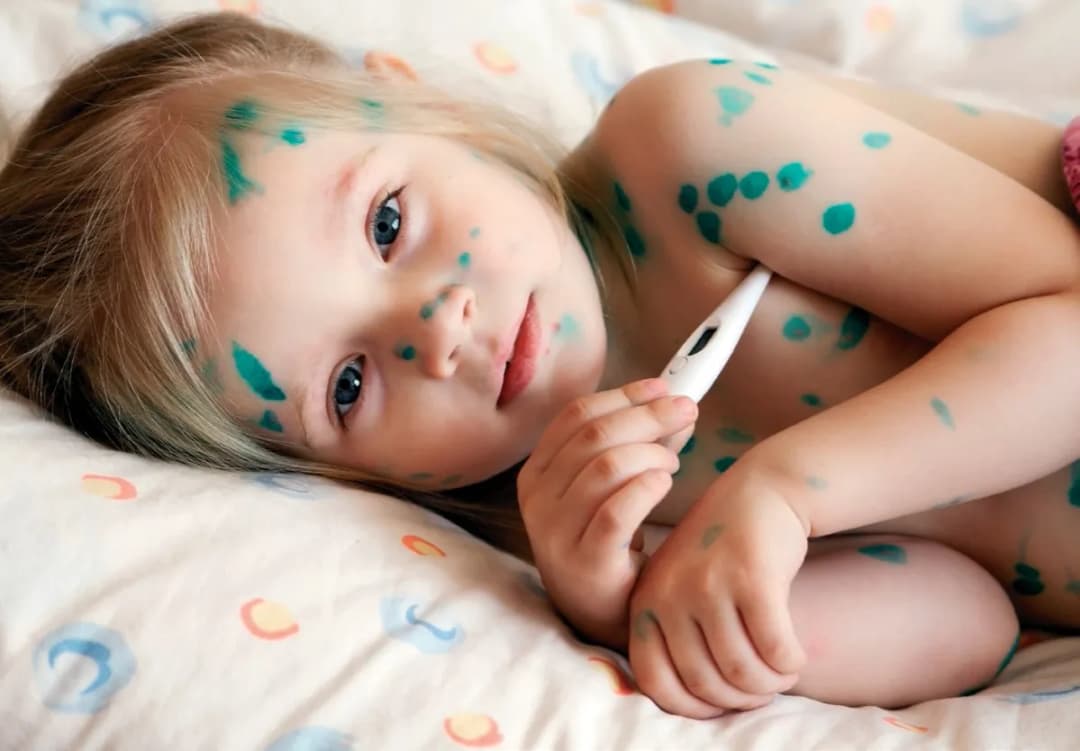 Ospa w przedszkolu co robić: kluczowe kroki dla rodziców