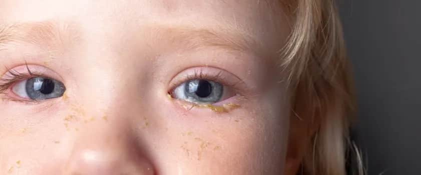 Dlaczego dziecku ropieją oczy? Poznaj przyczyny i objawy