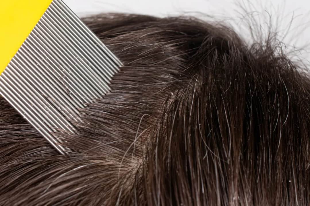 Jak pozbyć się gnid z włosów dziecka - skuteczne metody i porady